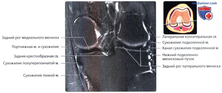Разрыв мениска заднего рога признаки. Разрыв заднего рога мениска. Мышцы коленного сустава мрт анатомия. Повреждение заднего рога медиального мениска.