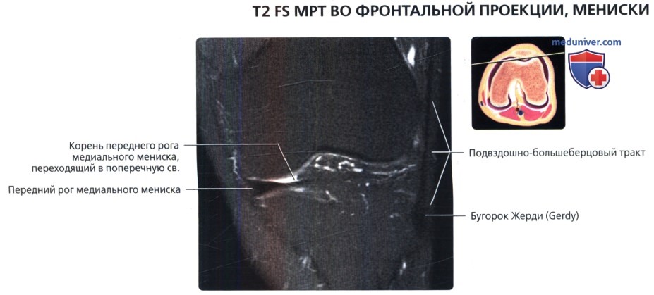 МРТ менисков коленного сустава во фронтальной проекции в норме