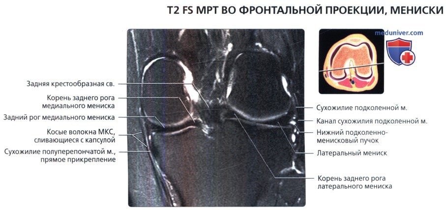 МРТ менисков коленного сустава во фронтальной проекции в норме
