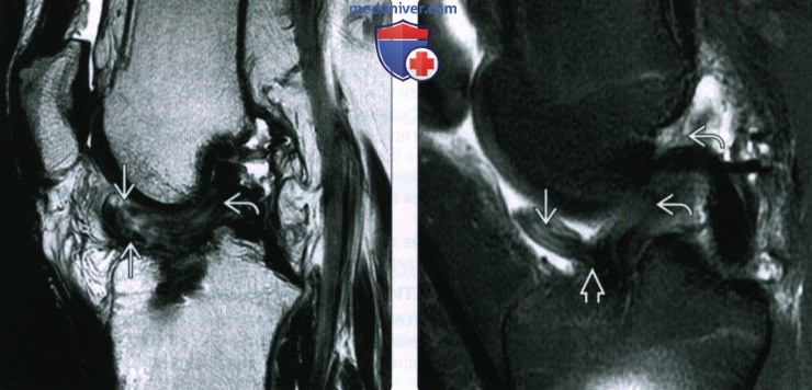 МРТ оценка передней крестообразной связки после операции