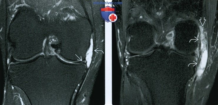 МРТ при околоменисковой кисте коленного сустава