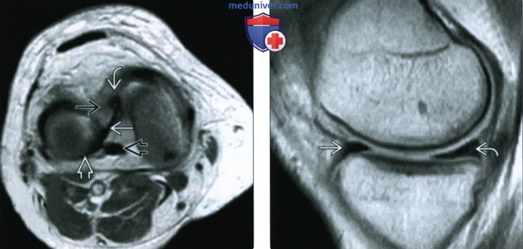 МРТ особенности и варианты анатомии менисков коленного сустава