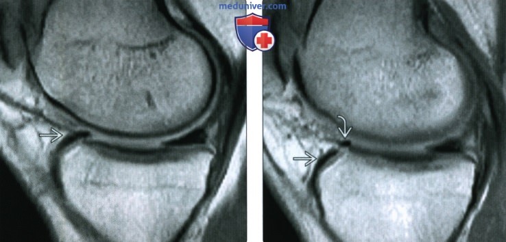 МРТ особенности и варианты анатомии менисков коленного сустава
