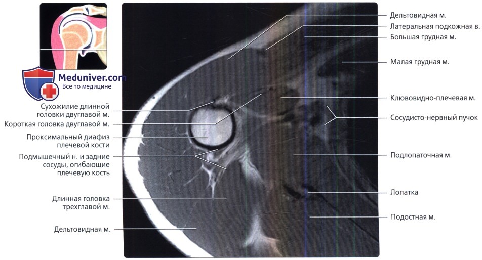 МРТ плечевого сустава в норме в аксиальной проекции