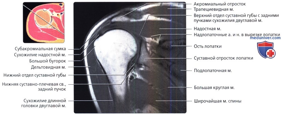 МРТ плечевого сустава в косой фронтальной проекции в норме