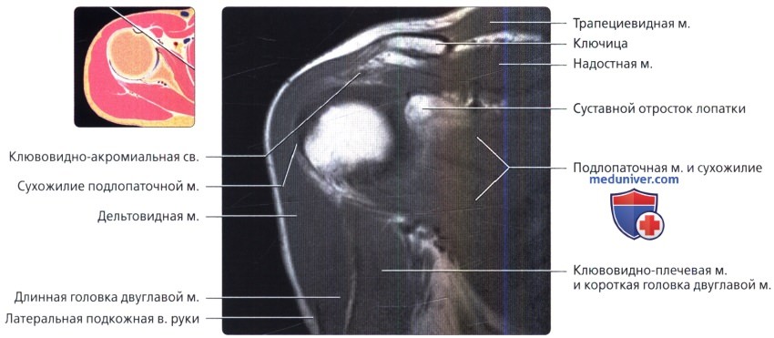 МРТ плечевого сустава в косой фронтальной проекции в норме