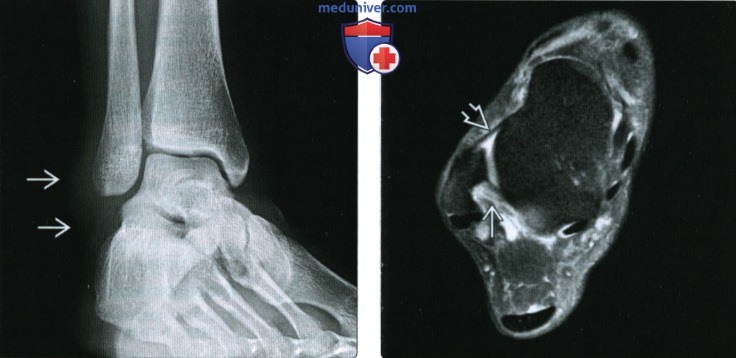 МРТ при повреждении связок голеностопного сустава