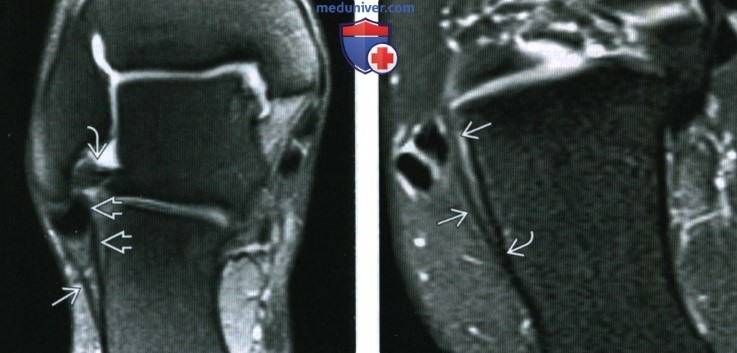 МРТ при повреждении связок голеностопного сустава