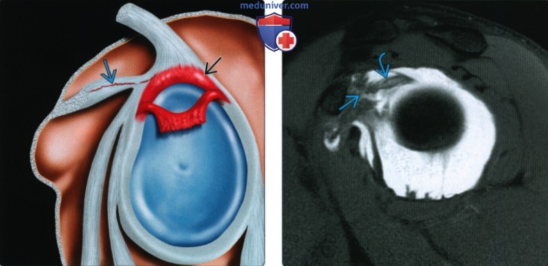 МРТ при распространенном переднем и заднем разрыве верхней губы плечевого сустава