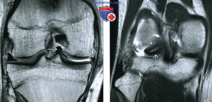 МРТ при разрыве мениска коленного сустава по типу ручки лейки
