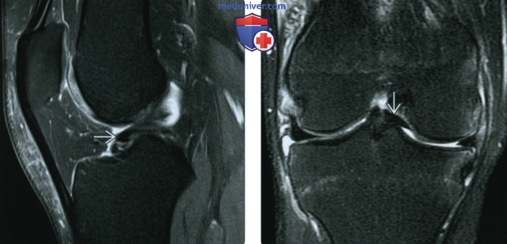МРТ при разрыве мениска коленного сустава по типу ручки лейки