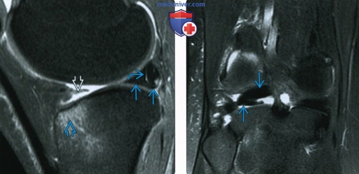 МРТ при разрывах менисков коленного сустава со смещением