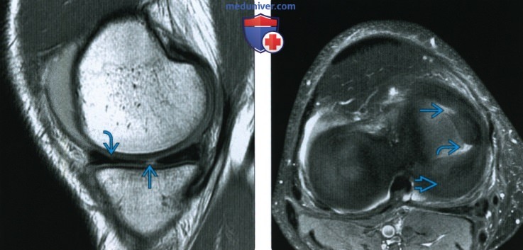 МРТ при разрывах менисков коленного сустава со смещением