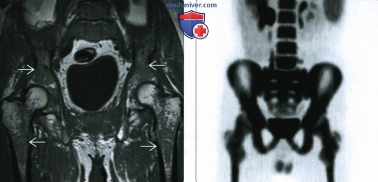 МРТ при повышенном и пониженном содержании клеток костного мозга