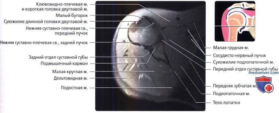 МРТ суставной губы плечевого сустава в норме
