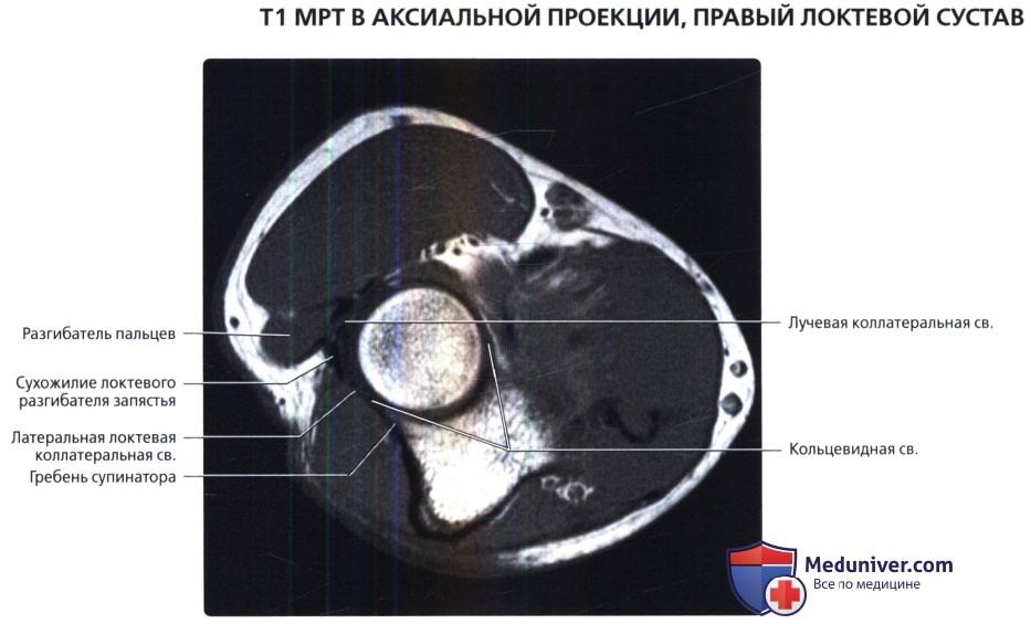 МРТ связок локтевого сустава в норме