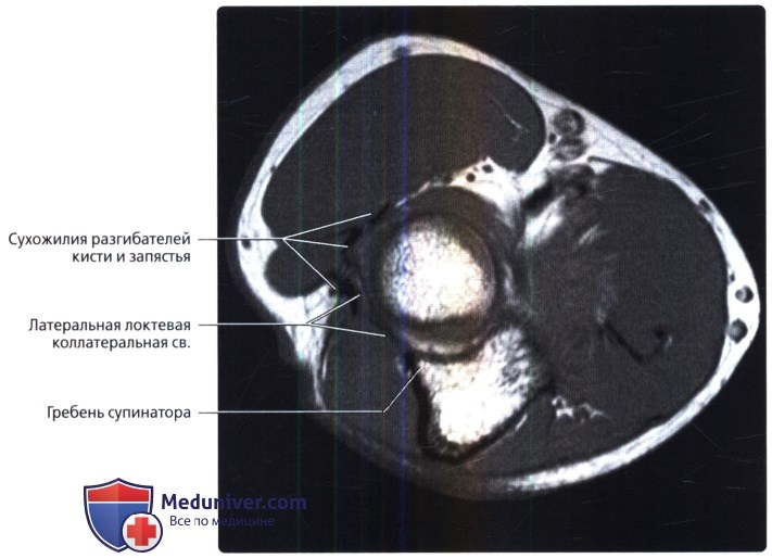МРТ связок локтевого сустава в норме