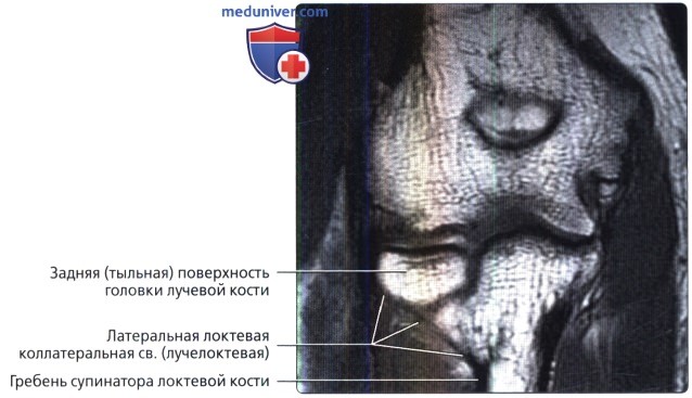 Артрография связок локтевого сустава в норме
