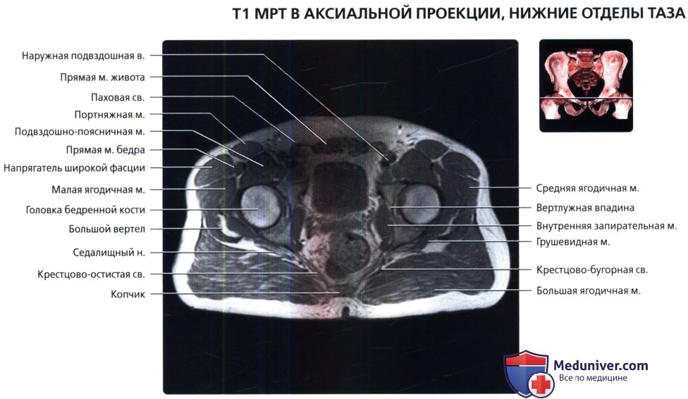 МРТ таза в аксиальной проекции в норме