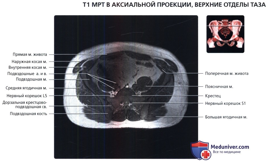 МРТ таза в аксиальной проекции в норме