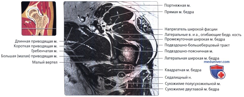 МРТ тазобедренного сустава в аксиальной проекции в норме
