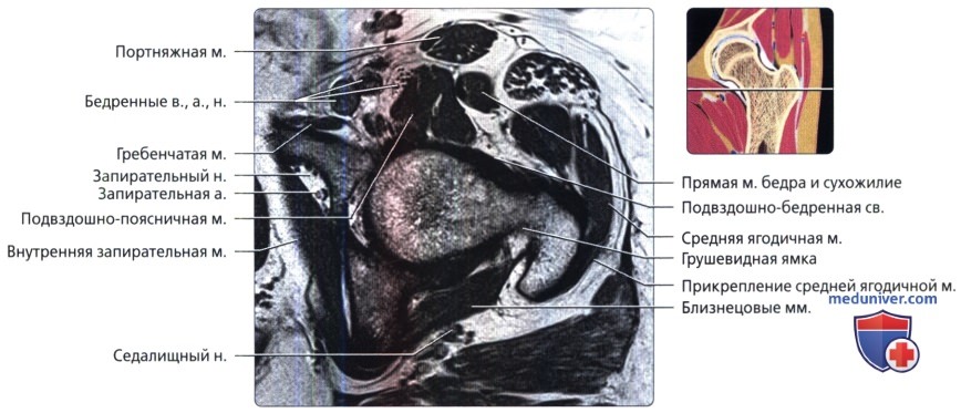 МРТ тазобедренного сустава в аксиальной проекции в норме