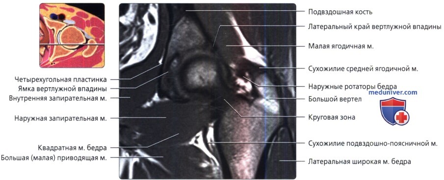 МРТ тазобедренного сустава во фронтальной проекции в норме