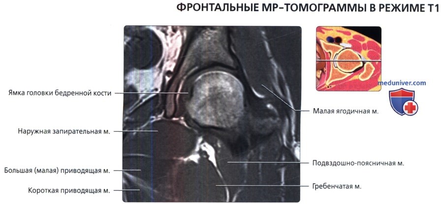 МРТ тазобедренного сустава во фронтальной проекции в норме