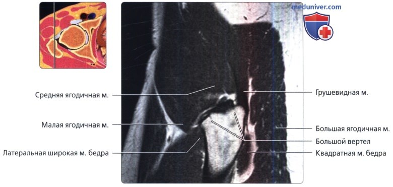 МРТ тазобедренного сустава в продольной проекции в норме