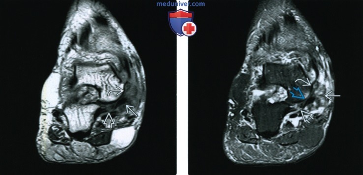 МРТ при травме подошвенной пяточно-ладьевидной связки