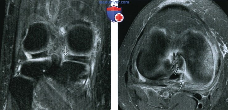 МРТ при травме ветви мениска коленного сустава