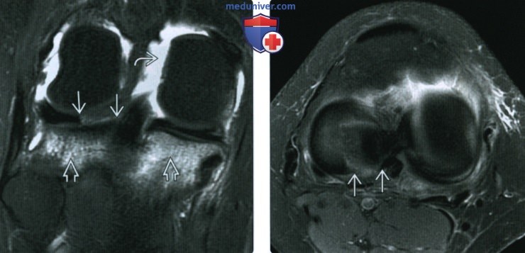 МРТ при травме ветви мениска коленного сустава