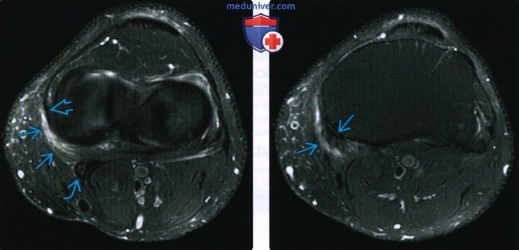 МРТ при травме заднемедиального угла коленного сустава