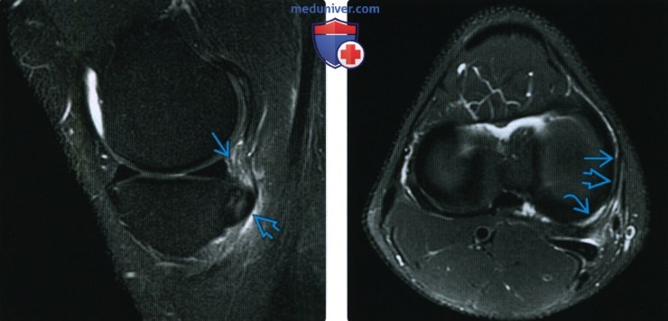 МРТ при травме заднемедиального угла коленного сустава