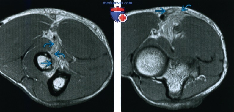 МРТ, УЗИ при повреждении сухожилия двуглавой мышцы на уровне локтевого сустава