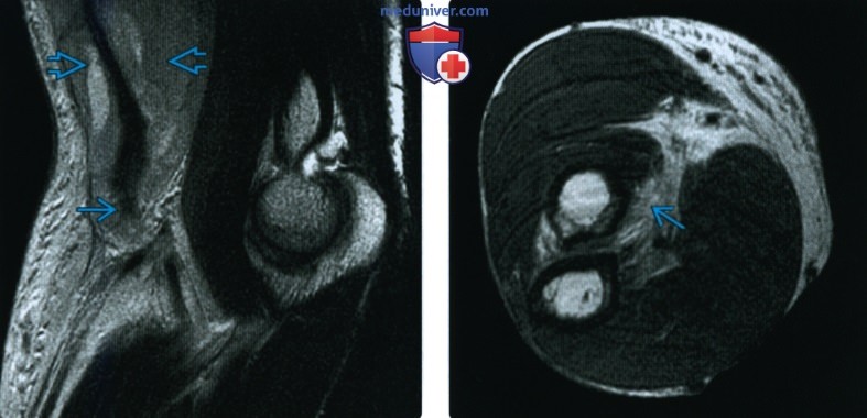 МРТ, УЗИ при повреждении сухожилия двуглавой мышцы на уровне локтевого сустава