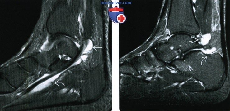 МРТ, УЗИ при разрыве, ущемлении или тендинопатии сухожилия длинного сгибателя большого пальца стопы