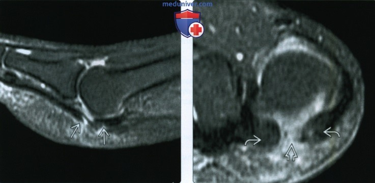 МРТ, УЗИ при разрыве, ущемлении или тендинопатии сухожилия длинного сгибателя большого пальца стопы