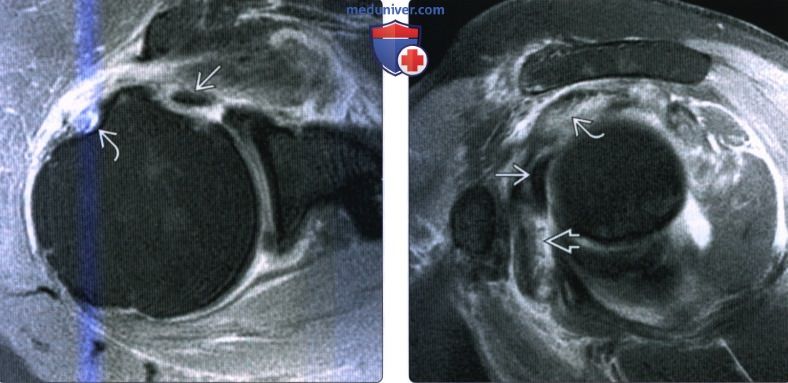 МРТ, УЗИ при тендинопатии двуглавой мышцы плеча