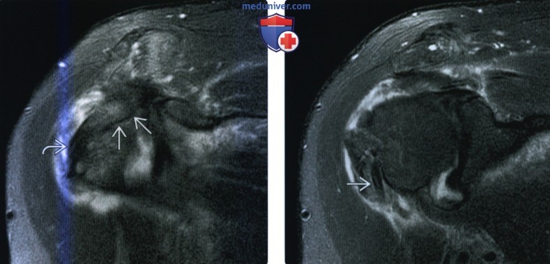 МРТ, УЗИ при тендинопатии двуглавой мышцы плеча