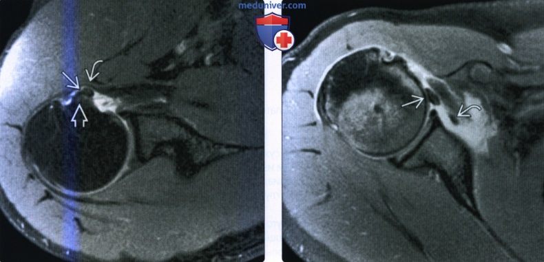 МРТ, УЗИ при вывихе сухожилия двуглавой мышцы плеча