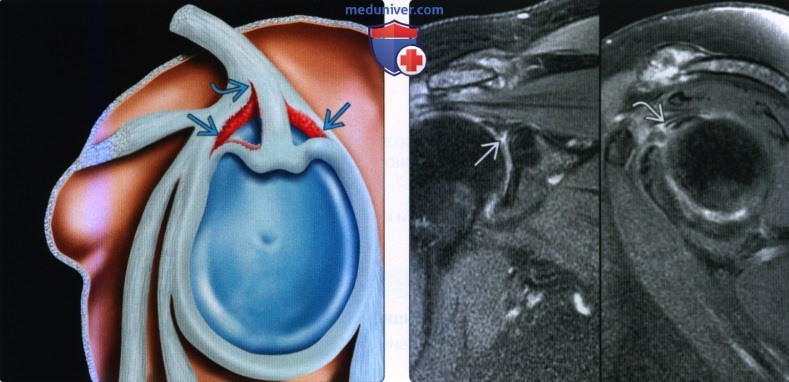 МРТ, УЗИ при внутрисуставном разрыве сухожилия двуглавой мышцы плеча