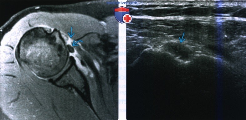 МРТ, УЗИ при внутрисуставном разрыве сухожилия двуглавой мышцы плеча