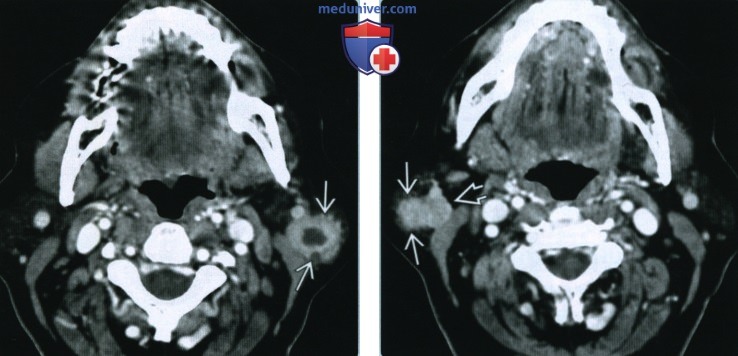 Мукоэпидермоидный рак околоушной железы - лучевая диагностика