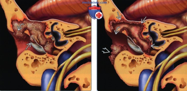 Муральная холестеатома - лучевая диагностика