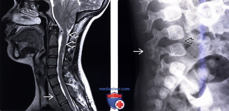 МРТ, рентгенограмма при нарушении сегментации позвонков