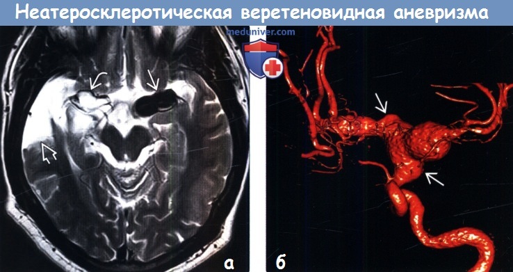 Неатеросклеротическая веретеновидная аневризма головного мозга на МРТ, ангиограмме