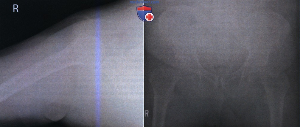 Признаки недостаточной экспозиции на цифровой (компьютерной) рентгенограмме и ее коррекция