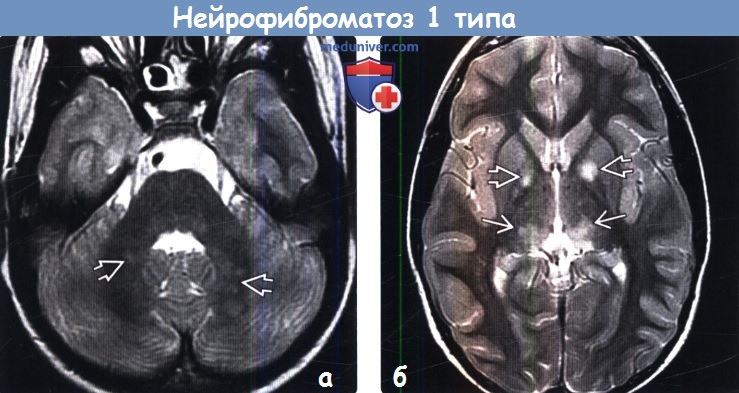 Нейрофиброматоз 1 типа на МРТ головного мозга