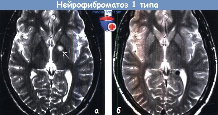 Нейрофиброматоз 1 типа на МРТ головного мозга